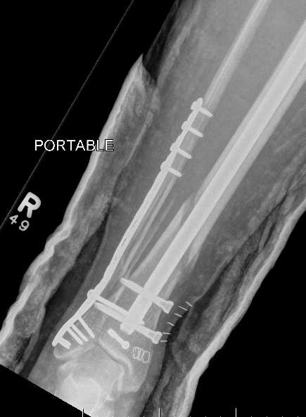 Fibular fixation Distal tibia